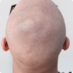 Mikropigmentacja skóry głowy z tyłu głowy Scalpmann