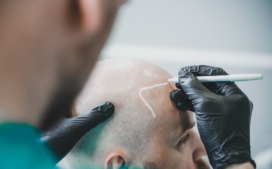 Wyznaczanie linii włosów podczas zabiegu mikropigmentacji skóry głowy