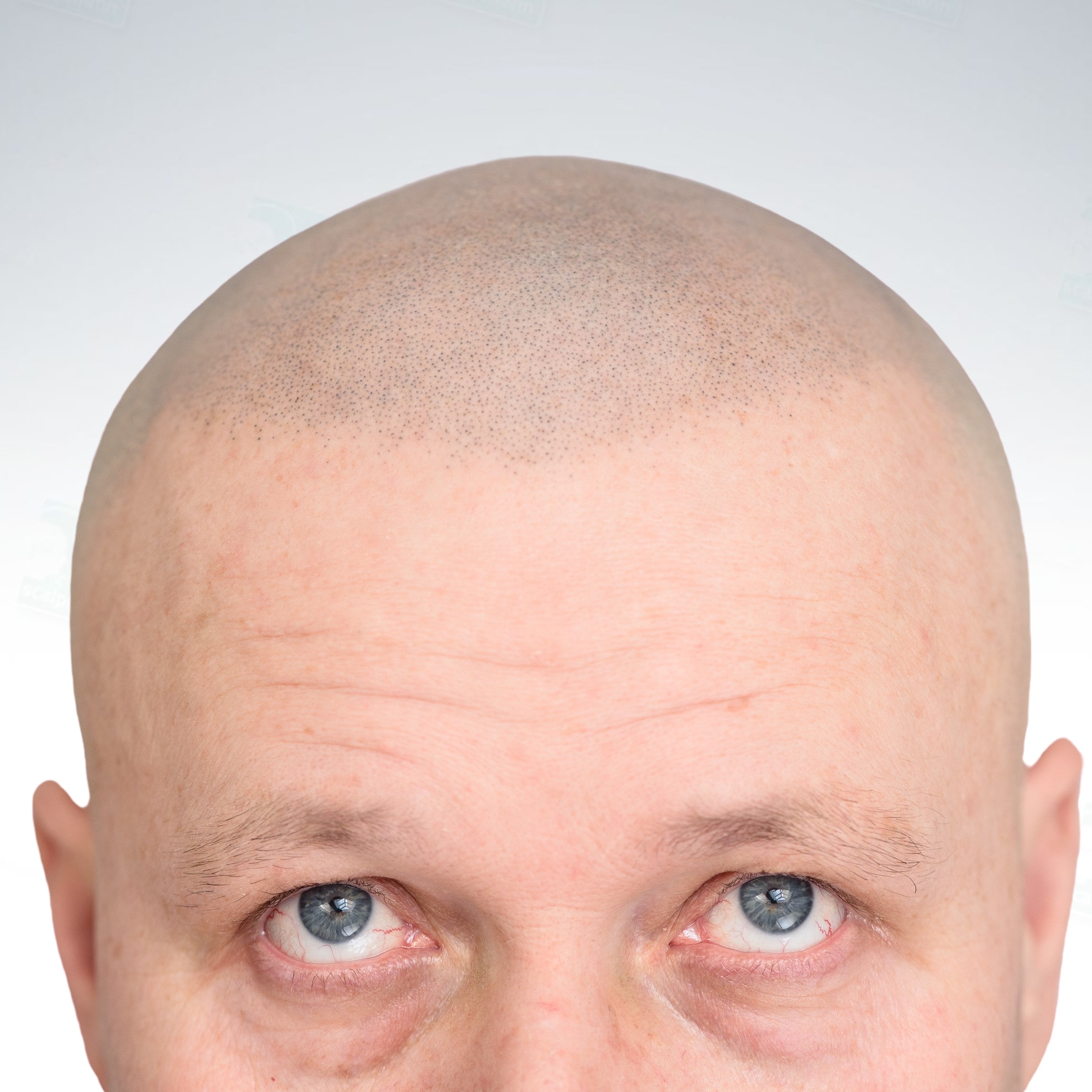 Mikropigmentacja skóry głowy z bliska