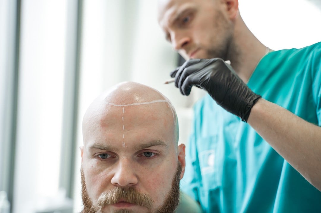 Scalp Micropigmentation Traning | Become a SMP Specialist