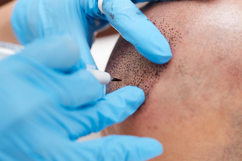Tatuaż imitujący włosy na głowie – innowacyjny sposób walki ze skutkami łysienia