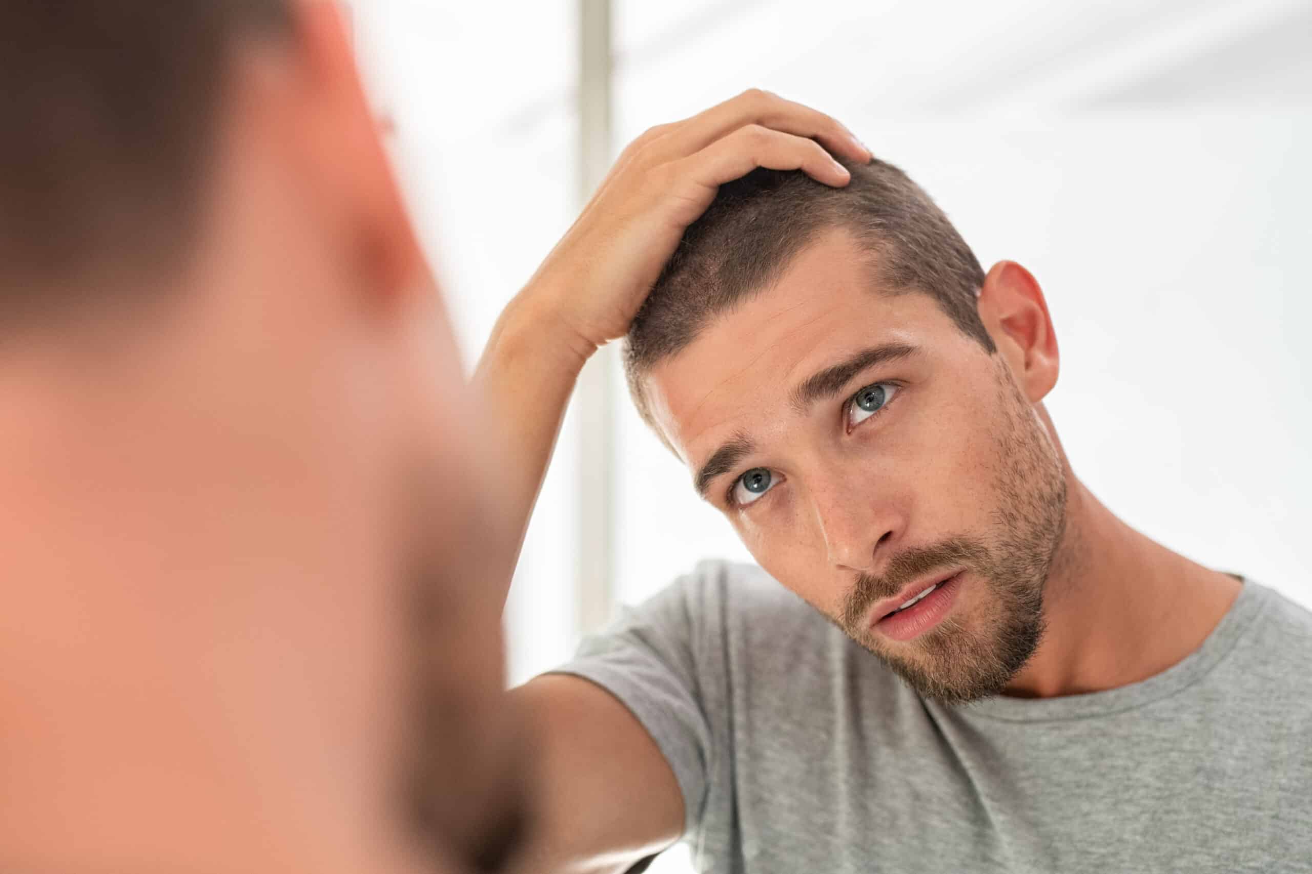 Przyczyny łysienia u mężczyzn