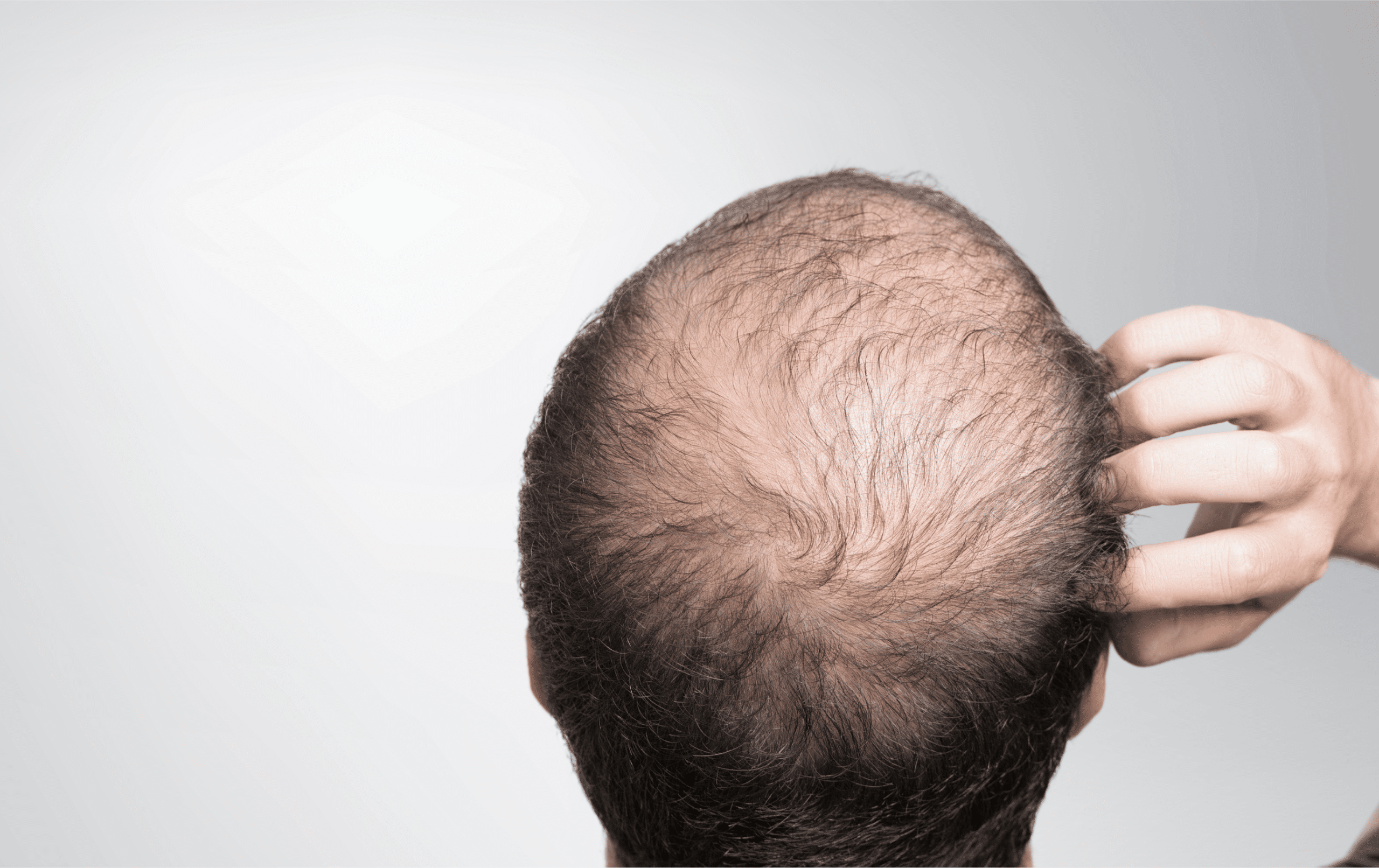 Najczęstsze przyczyny wypadania włosów u mężczyzn